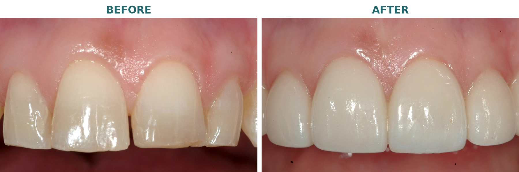  Porcelain Veneers in Virginia Beach